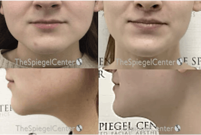 Mandible Contouring Before & After Gallery - Patient 398329 - Image 1