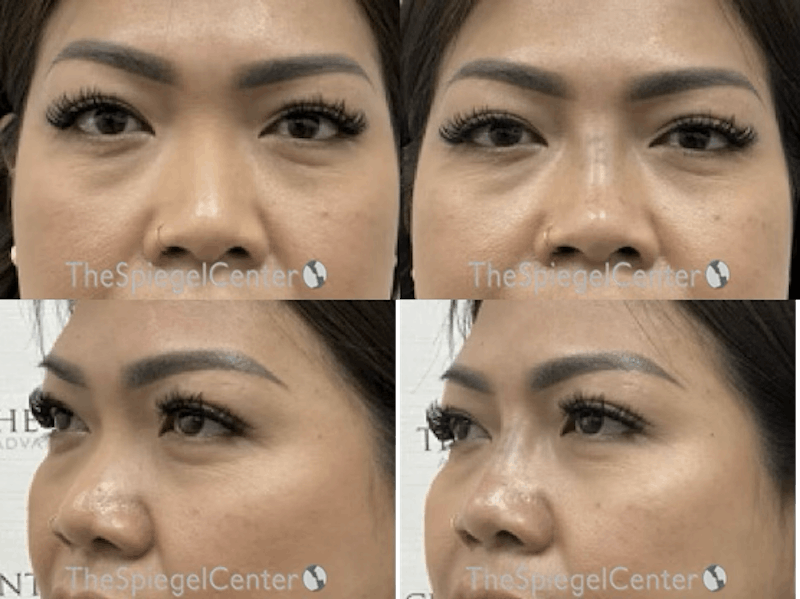Non-Surgical Rhinoplasty / Nose Filler Before & After Gallery - Patient 104160 - Image 1