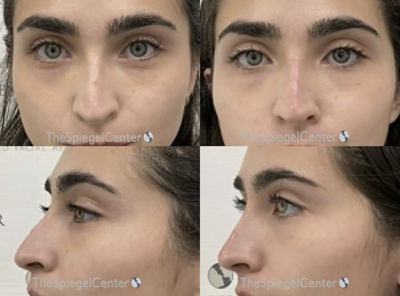 Non-Surgical Rhinoplasty / Nose Filler Before & After Gallery - Patient 149439 - Image 1