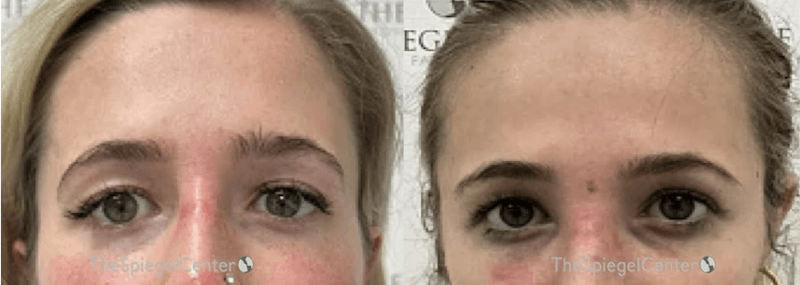 Temple Filler Before & After Gallery - Patient 315624 - Image 1