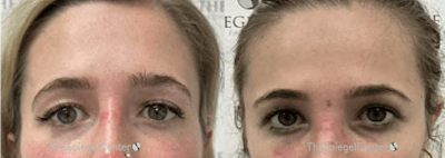 Temple Filler Before & After Gallery - Patient 315624 - Image 1