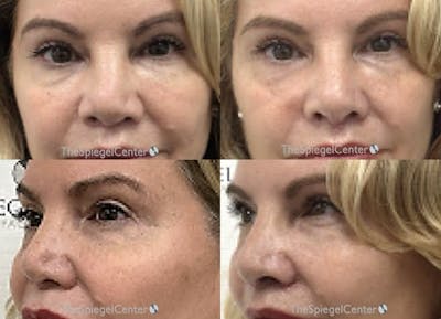 Non-Surgical Rhinoplasty / Nose Filler Before & After Gallery - Patient 219069 - Image 1