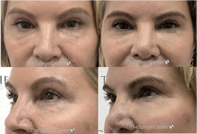 Tear Trough / Under Eye Fillers Before & After Gallery - Patient 321618 - Image 1
