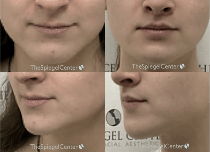 Lip Lift Before & After Gallery - Patient 411311 - Image 1