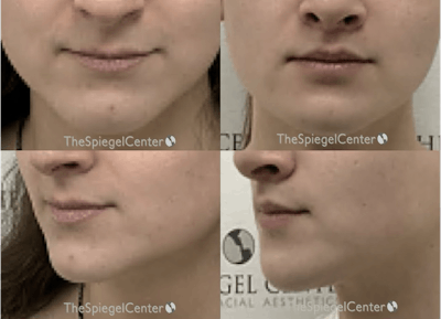 Lip Lift Before & After Gallery - Patient 411311 - Image 1