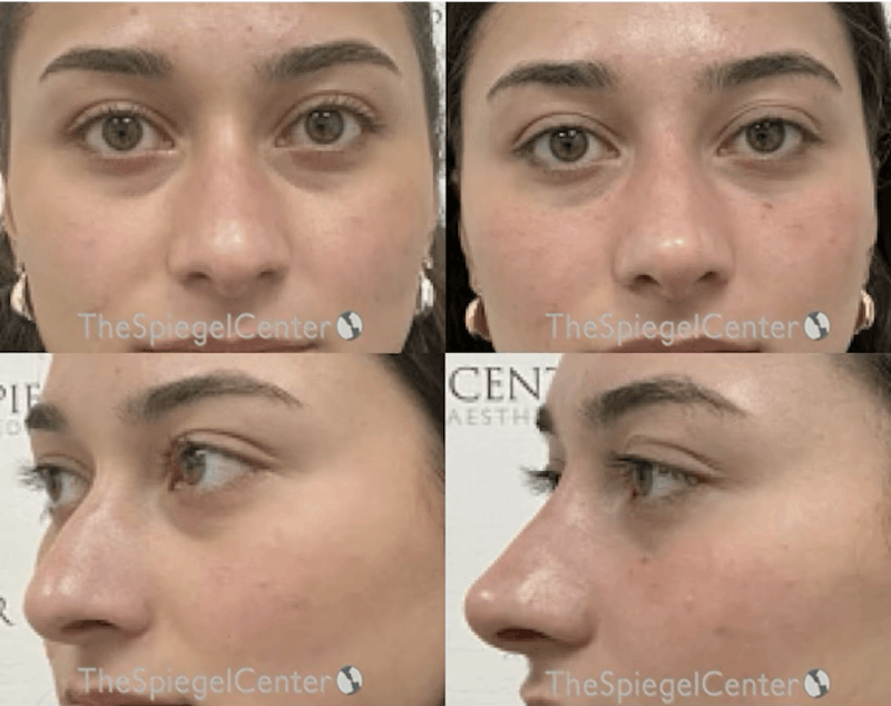 Non-Surgical Rhinoplasty / Nose Filler Before & After Gallery - Patient 156450 - Image 1