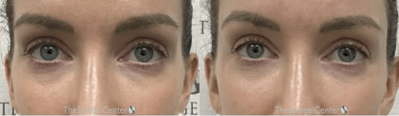 Temple Filler Before & After Gallery - Patient 290635 - Image 1