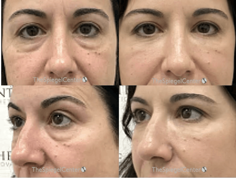 Tear Trough / Under Eye Fillers Before & After Gallery - Patient 199241 - Image 1