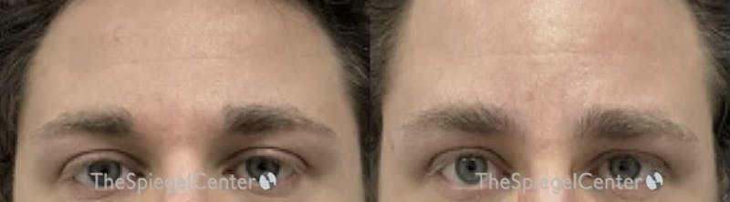 Browlift / Fox Eye Lift Before & After Gallery - Patient 314556 - Image 1