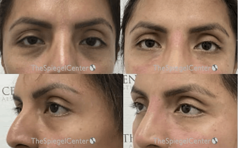 Tear Trough / Under Eye Fillers Before & After Gallery - Patient 158549 - Image 1