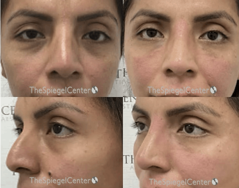 Non-Surgical Rhinoplasty / Nose Filler Before & After Gallery - Patient 960535 - Image 1