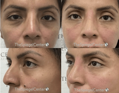Non-Surgical Rhinoplasty / Nose Filler Before & After Gallery - Patient 960535 - Image 1