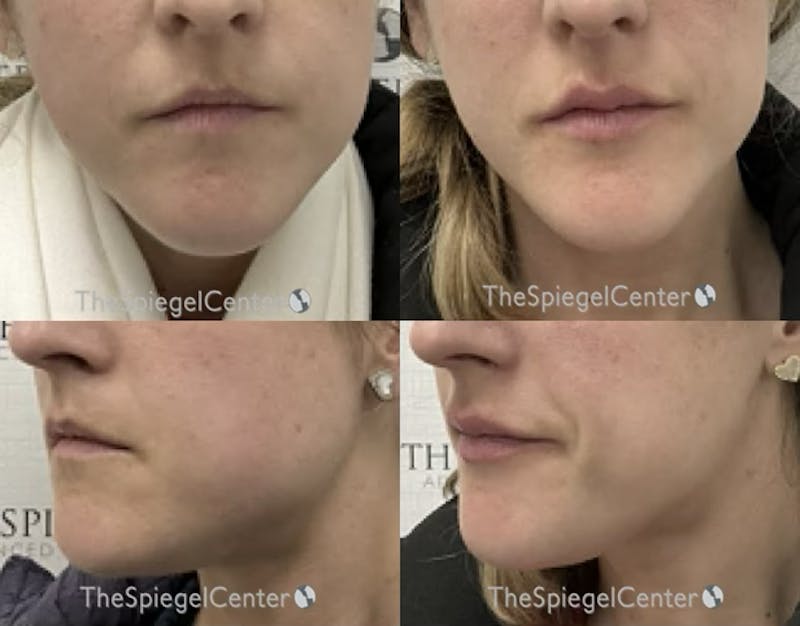 Masseter Botox Before & After Gallery - Patient 297576 - Image 1