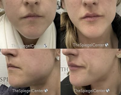 Masseter Botox Before & After Gallery - Patient 297576 - Image 1