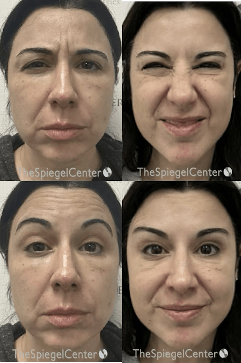 Botox / Dysport / Jeuveau / Xeomin Before & After Gallery - Patient 428318 - Image 1