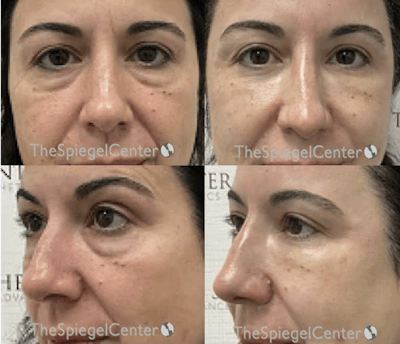 Non-Surgical Rhinoplasty / Nose Filler Before & After Gallery - Patient 194082 - Image 1