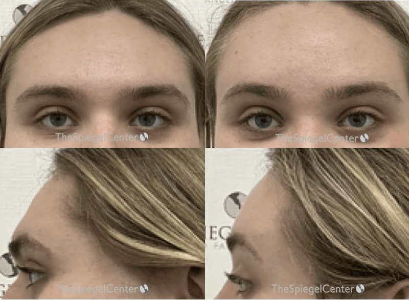 Forehead Contouring Before & After Gallery - Patient 322399 - Image 1