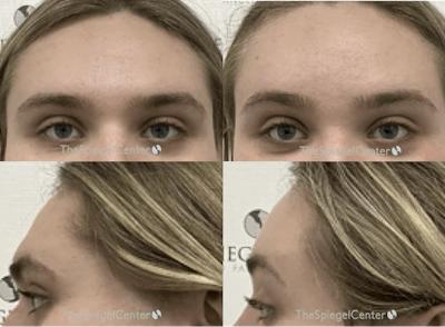 Forehead Contouring Before & After Gallery - Patient 322399 - Image 1
