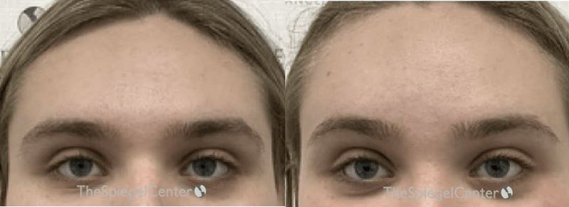 Browlift / Fox Eye Lift Before & After Gallery - Patient 427558 - Image 1