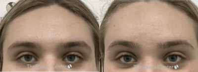 Browlift / Fox Eye Lift Before & After Gallery - Patient 427558 - Image 1
