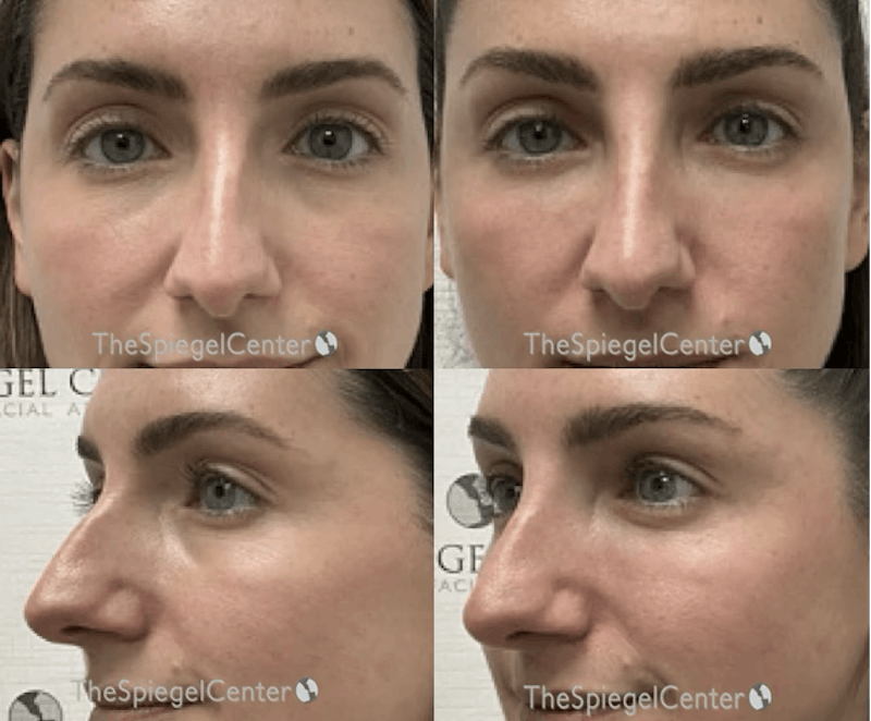 Non-Surgical Rhinoplasty / Nose Filler Before & After Gallery - Patient 145721 - Image 1