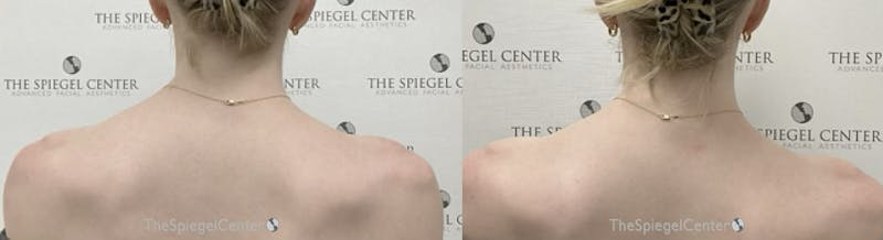 Trapezius Botox (TrapTox) Before & After Gallery - Patient 109517 - Image 1