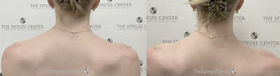 Trapezius Botox (TrapTox) Before & After Gallery - Patient 109517 - Image 1