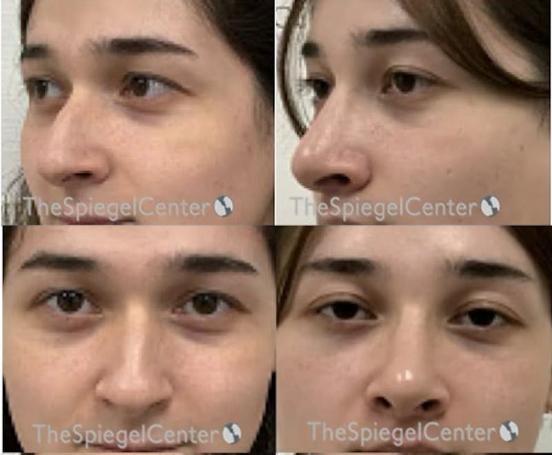 Rhinoplasty Before & After Gallery - Patient 519011 - Image 1