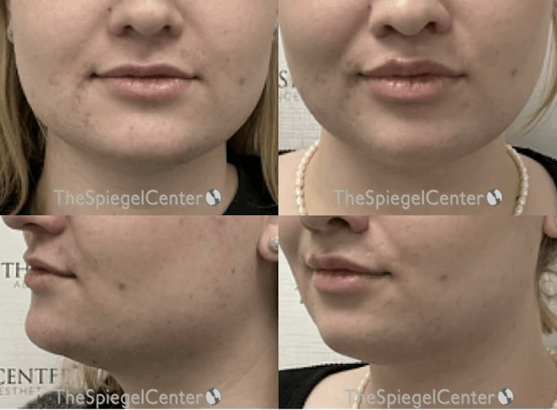 Mandible Contouring Before & After Gallery - Patient 317664 - Image 1