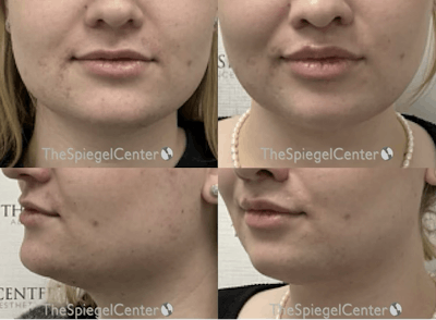 Mandible Contouring Before & After Gallery - Patient 317664 - Image 1