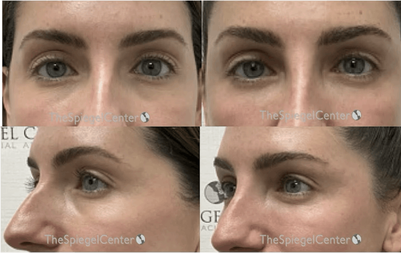 Tear Trough / Under Eye Fillers Before & After Gallery - Patient 353647 - Image 1