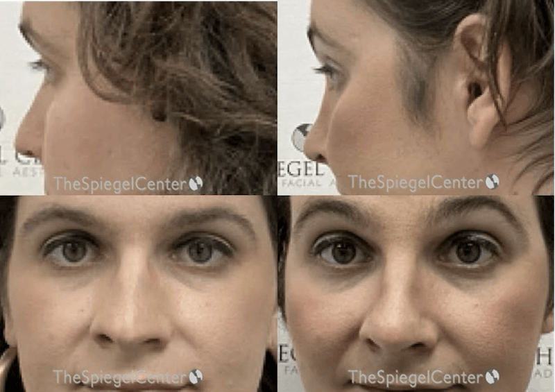 Cheek Implants Before & After Gallery - Patient 300318 - Image 1