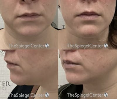 Chin Filler Before & After Gallery - Patient 404325 - Image 1