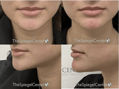 Chin Filler Before & After Gallery - Patient 195701 - Image 1