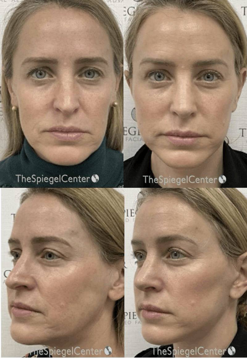 Facelift Before & After Gallery - Patient 327110 - Image 1