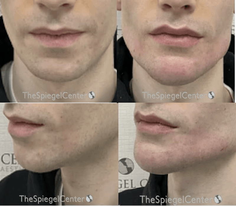 Chin Filler Before & After Gallery - Patient 223993 - Image 1