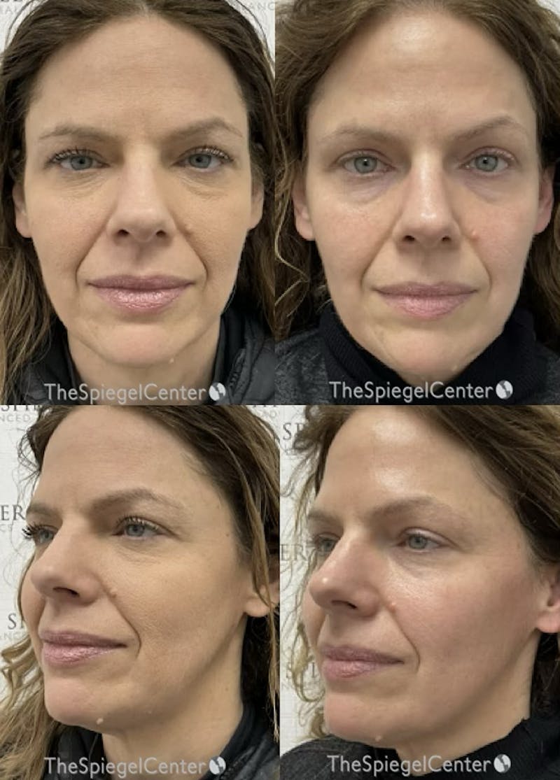 Masseter Botox Before & After Gallery - Patient 119278 - Image 1