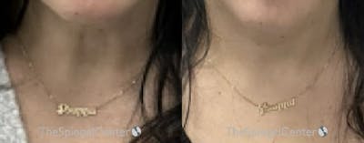 Neck Botox Before & After Gallery - Patient 670154 - Image 1