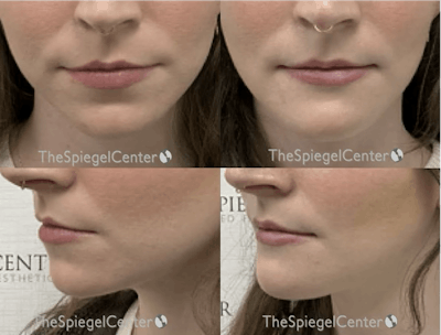 Chin Augmentation Before & After Gallery - Patient 217391 - Image 1