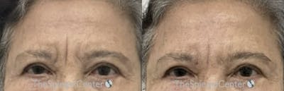 Deep 11 Before & After Gallery - Patient 287692 - Image 1