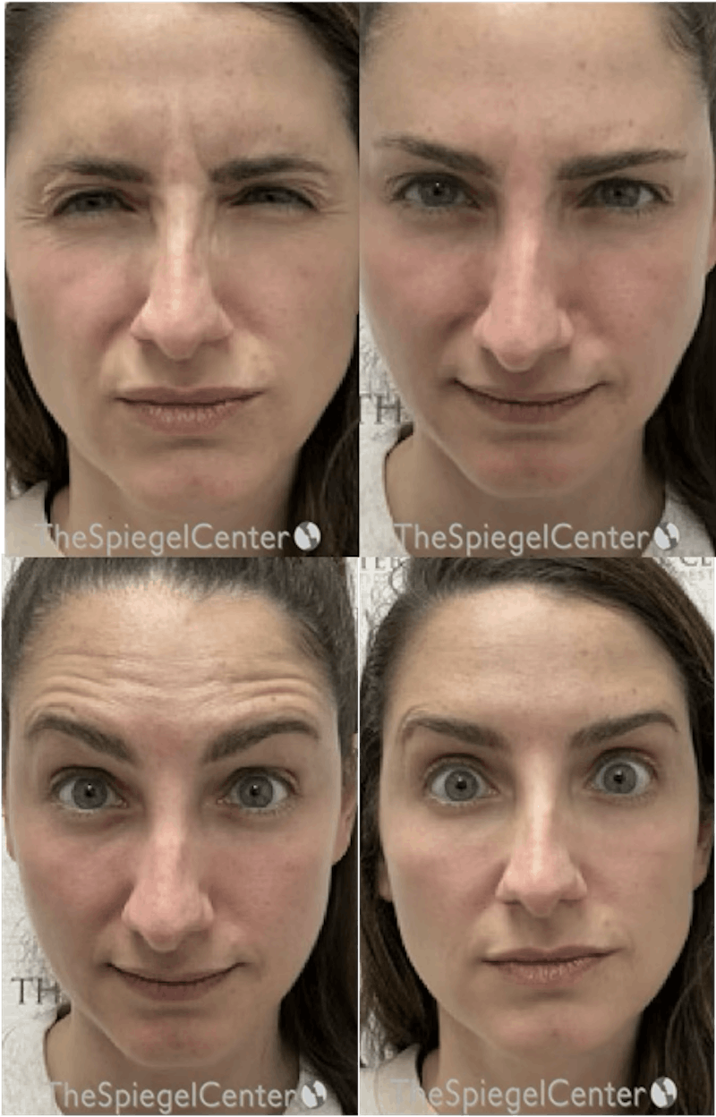 Botox / Dysport / Jeuveau / Xeomin Before & After Gallery - Patient 678264 - Image 1