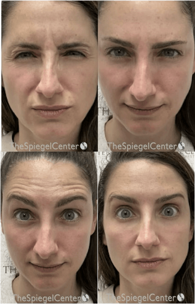 Botox / Dysport / Jeuveau / Xeomin Before & After Gallery - Patient 678264 - Image 1