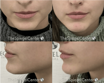 Chin Filler Before & After Gallery - Patient 157796 - Image 1