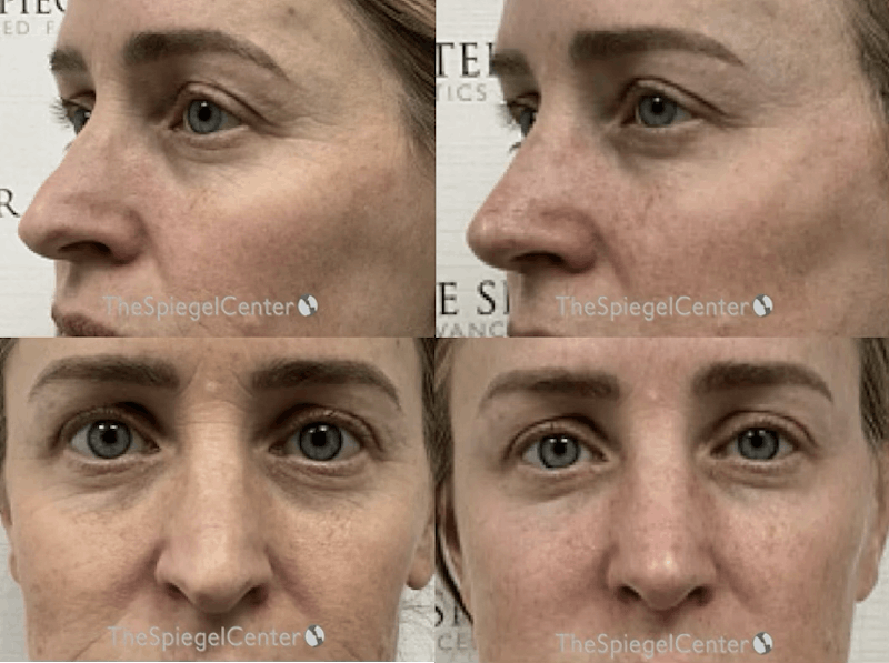 Rhinoplasty Before & After Gallery - Patient 353481 - Image 1