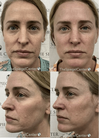 CO2 Laser Before & After Gallery - Patient 303110 - Image 1