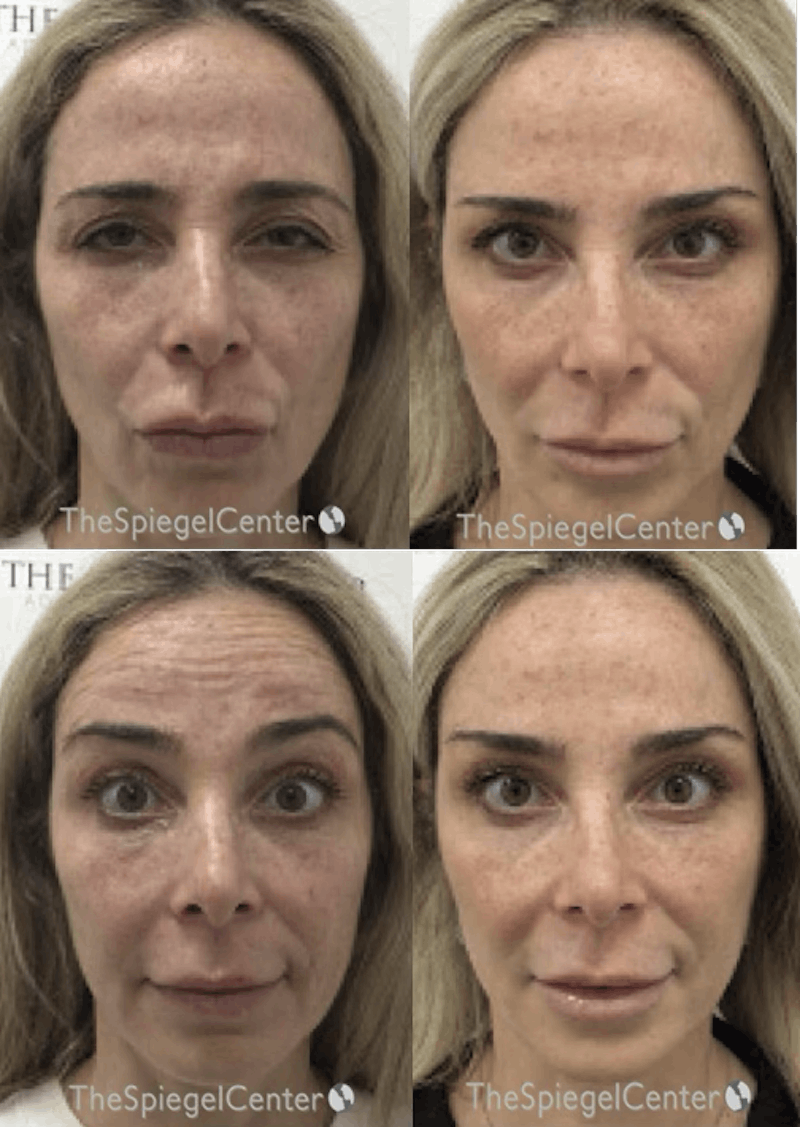 Botox / Dysport / Jeuveau / Xeomin Before & After Gallery - Patient 263089 - Image 1