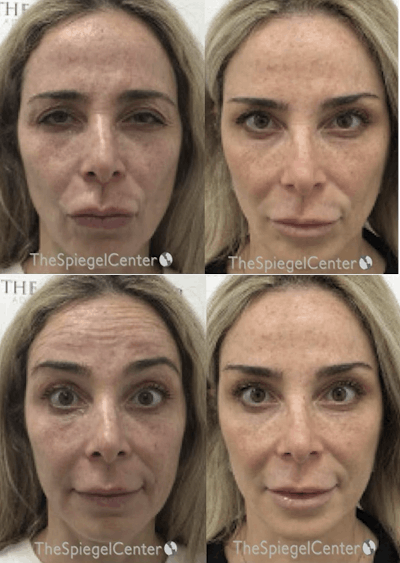 Botox / Dysport / Jeuveau / Xeomin Before & After Gallery - Patient 263089 - Image 1