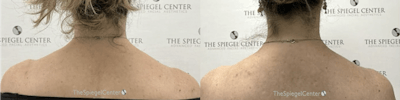 Trapezius Botox (TrapTox) Before & After Gallery - Patient 629947 - Image 1