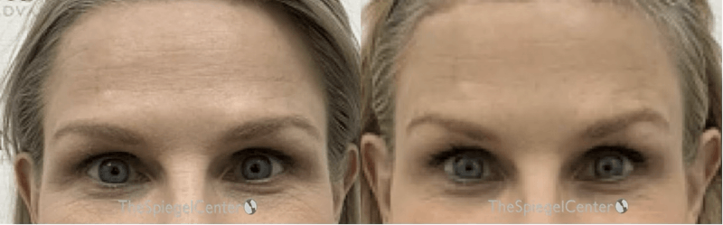 Browlift / Fox Eye Lift Before & After Gallery - Patient 371699 - Image 1