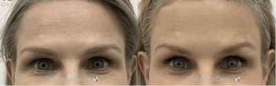 Browlift / Fox Eye Lift Before & After Gallery - Patient 371699 - Image 1